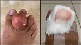 腳趾,雞蛋,腫起,關節炎,寄生,痛風,爆開