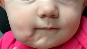 女嬰有兩張嘴（圖／翻攝自英國醫學期刊）