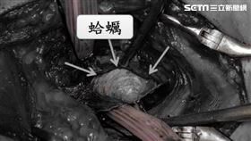 安南醫院,消化科,許秉毅,蛤蜊,食道
圖／安南醫院提供