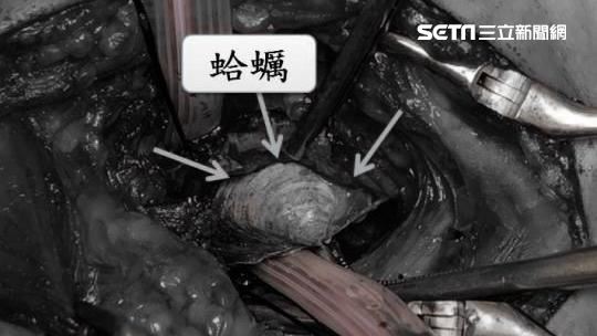 吃海鮮粥太急　4公分蛤蜊變食道殺手