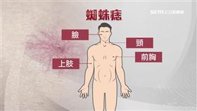 皮膚蜘蛛痣.手變