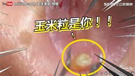 耳朵擠出「玉米粒」。（圖／InitialBeauty 天生美肌YouTube授權）