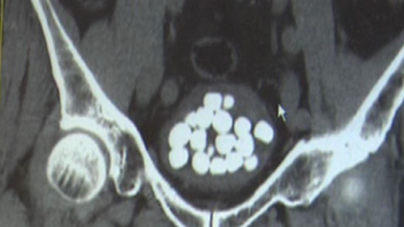 翁肚子痛　醫驚：體內一窩「鵪鶉蛋」