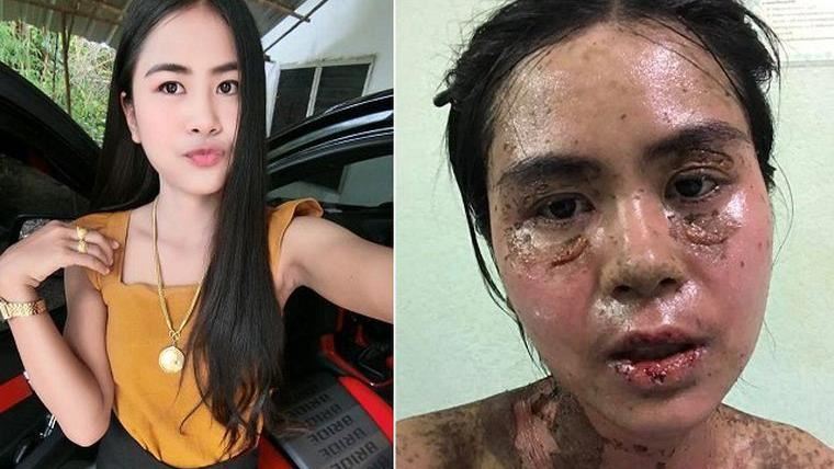 亂吃止痛藥　正妹皮膚潰爛燒焦差點死