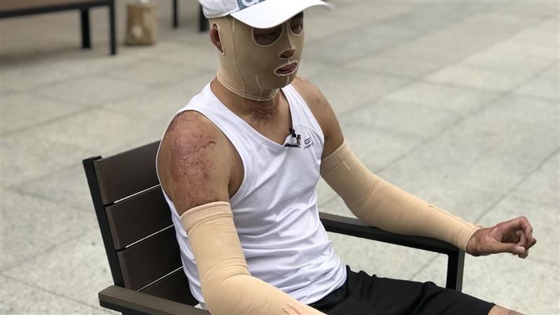 獨／氣爆毀容截肢傷者　曝罷韓原因