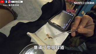 耳結石塞滿耳道　清空暢通感秒浮現