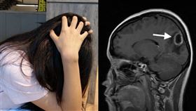 28歲女頭痛一驗「顱腦包滿濃」急開刀…兇手竟是一顆痘痘。（圖／翻攝自微博）