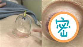 拔罐,中醫,治療,水泡,濕氣,溫度,時間