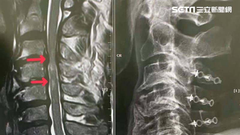 63歲獨居單身農　頸椎狹窄四肢險癱