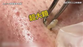 ▲因處於青春期階段的男性，皮脂的分泌較為旺盛。（圖／Jin Yan 靜妍美學  授權）