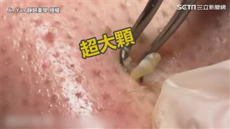黑頭粉刺飽滿噴發　連擠3大顆超舒壓