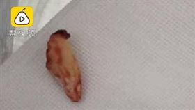 廣東,梅州,公雞,雞趾,化膿(梨視頻)