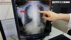 少女淋巴癌（新竹馬偕提供）