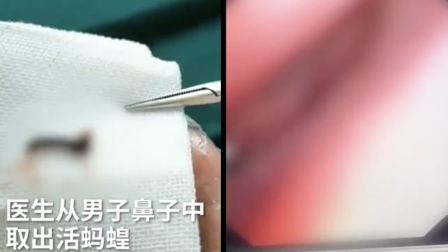 鼻子癢…醫夾出活螞蝗　蠕動片嚇瘋網