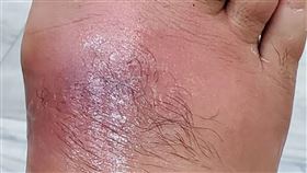 調養身體去針灸  扎針處紅腫變蜂窩性組織炎40多歲男子接受針灸治療調養身體，但扎針的腳背皮膚紅腫，原以為是被蚊蟲叮咬，卻越腫越大、甚至痛到無法行走，到醫院急診經醫師檢查後發現，是細菌造成感染引發蜂窩性組織炎，搭配抗生素藥物治療後，傷口已逐漸好轉。（門諾醫院提供）中央社記者李先鳳傳真　109年6月15日