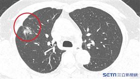 近1、2年診斷出罹患多發性肺癌的患者日益增加，且以無抽菸習慣的女性患者為多。（圖／台北慈濟醫院提供）