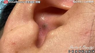 耳朵藏大黑頭　美容師擠三次逼出粉刺
