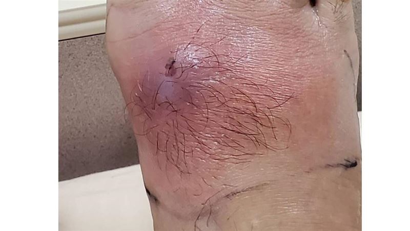 大家都做錯！他冬天做1事竟蜂窩性組織炎