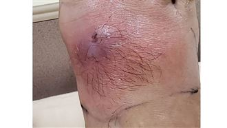 大家都做錯！他冬天做1事竟蜂窩性組織炎