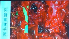 脊椎中風（圖／記者許書萓攝影）