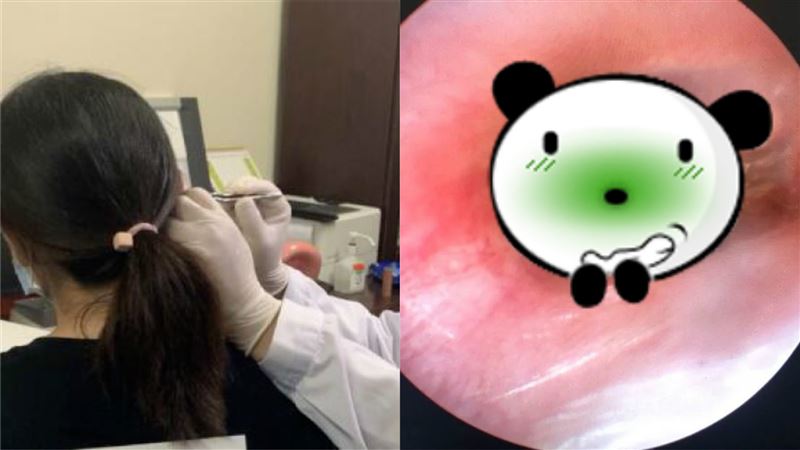 她起床突聽不到　醫挖出一坨黑色物體
