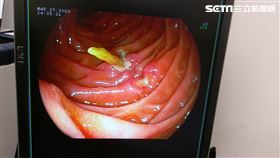 朱先生卡在十二指腸的牙籤。（圖／長安醫院提供）