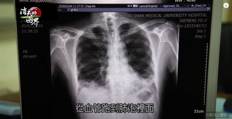 「間質幹細胞」成再生醫學新希望