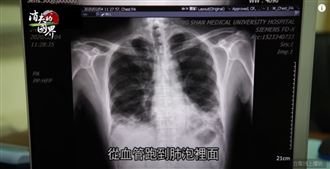 「間質幹細胞」成再生醫學新希望