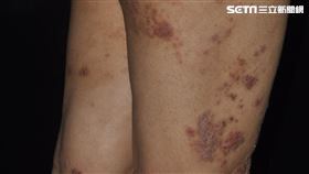 濕疹（皮膚科醫師黃毓惠提供）