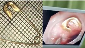 10月大嬰兒，誤吞蚊帳別針，媽媽一看蚊帳，即時送醫救回一命。（圖／翻攝自看看新聞微博）