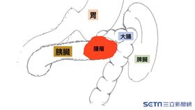 胰臟癌（中國醫藥大學新竹附設醫院提供）