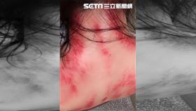  台中一名老闆娘小勳長相甜美，在西屯區經營蔥油餅小吃攤，去年因報導爆紅，有「台中林熙蕾」稱號。今（18）日她在臉書粉絲團po出一張刮痧後鮮紅的背部照，讓不少粉絲嚇得直呼「還以為家暴呢！」（圖／翻攝自臉書戀愛美式蔥油餅）