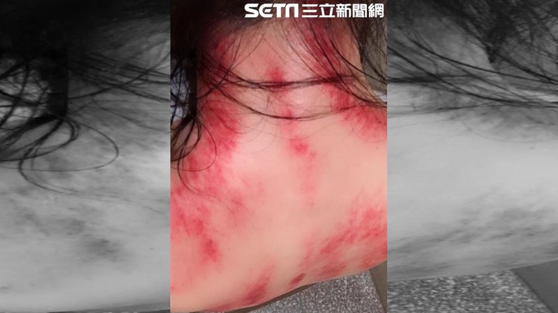 不是所有中暑都可刮痧！中醫這樣說…
