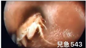 醫師分享以為一位小姐以為耳朵癢結果挖著挖著有點噁心，就醫檢查竟然發現耳朵裡頭竟然有一整隻蟑螂。（圖／吳昌騰醫師授權提供）


