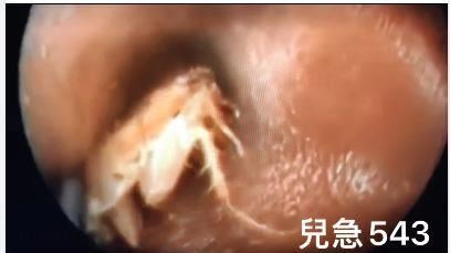 耳朵癢癢的…30歲女竟挖出駭人蟲子