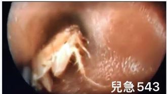 耳朵癢癢的…30歲女竟挖出駭人蟲子