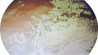 耳朵也會長黴菌　一舉動做過頭引感染