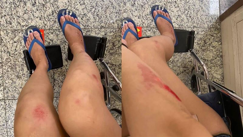 長腿妹被車撞！無照男扯神邏輯求私了