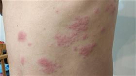 壓力,紅疹,抽痛,皮膚病,衛福部彰化醫院,莊佳慧,帶狀皰疹,皮蛇