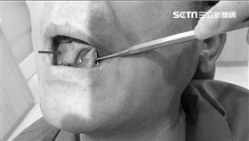 男嘴破、生殖器長水泡　以為是火氣大…竟是致命罕病病徵（圖／資料畫面-非當事人）