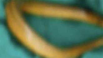 男將30CM黃鱔塞入肛門　醫開刀見畫面嚇傻