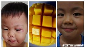 小兄弟吃芒果過敏（新竹馬偕提供）