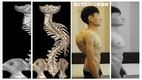 脊椎神醫　助「忍者龜」青年重生（圖／翻攝畫面）