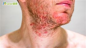 名家專用／NOW健康／許多人過敏常反覆發作，治療不得其法，現代醫學發現，身體之所以出現過敏症狀，源自於體內累積許多無法代謝的毒素。(勿用)