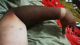 曬傷,烤焦,黑炭,繞境,大甲媽祖.防曬,皮膚癌