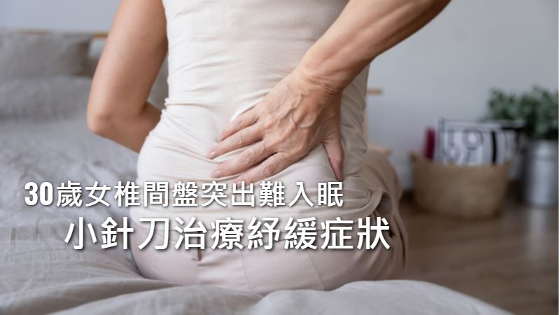 椎間盤突出導致痠痛痲　小針刀治療痠