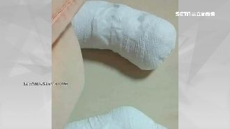 遭繼父燙女童已安置　親友爭取監護權