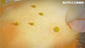 三伏貼療程需在背上貼敷藥餅。（圖／台北慈院提供）
