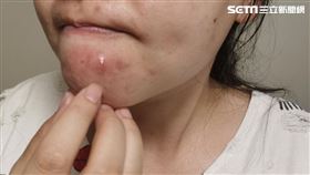 痘花妹示意圖（圖／台北醫院提供）