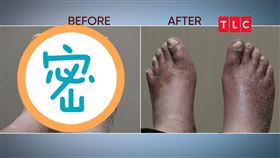 腳,灰指甲,雞眼,皮屑。圖／TLC提供
